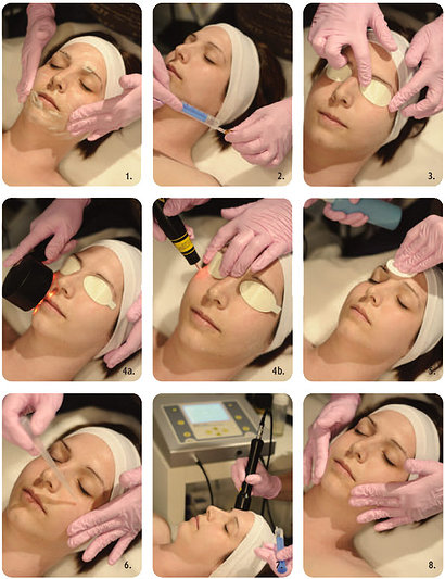 meso-i-laser
